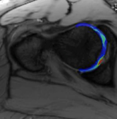 Cartilage Mapping Image