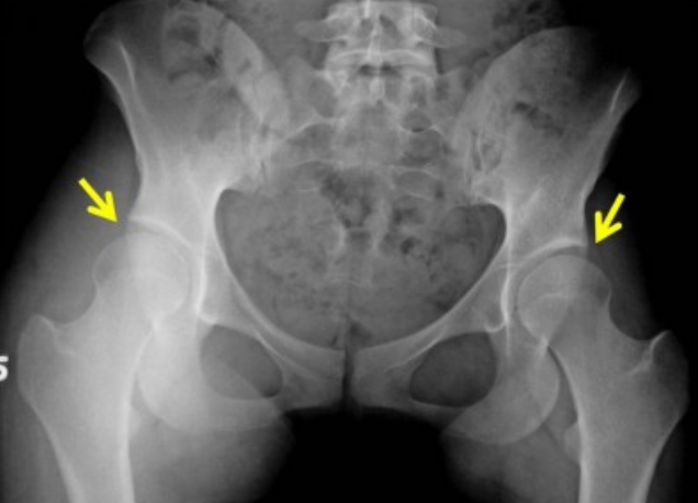 Sport Hip Injuries