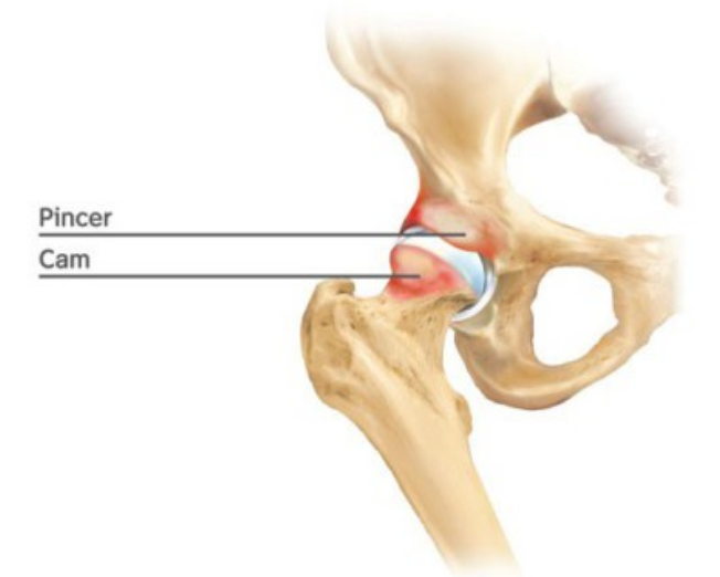 Sport Hip Injuries