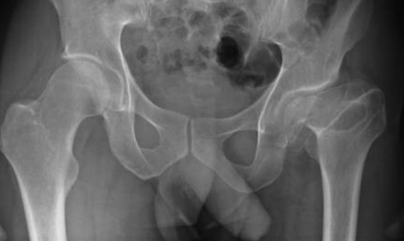 Sport Hip Injuries