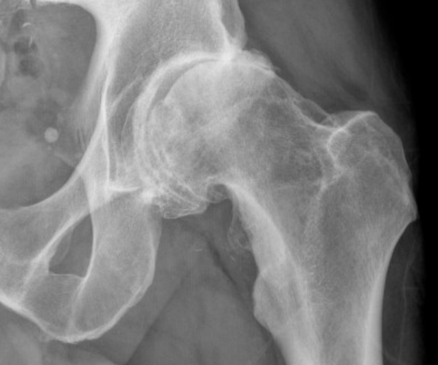 Sport Hip Injuries