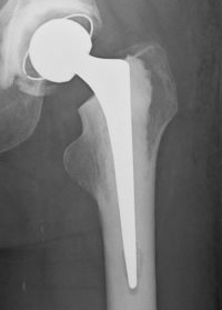 Total Hip Replacement London | Consultant Orthopaedic Hip Surgeon